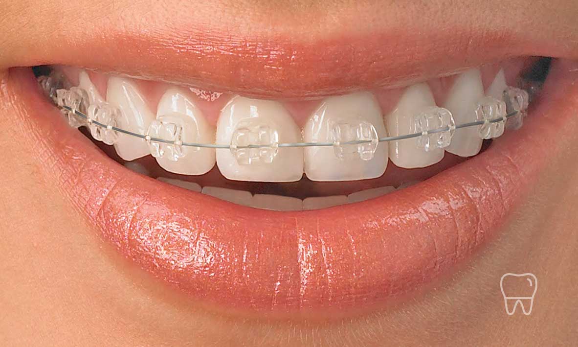 Ceramic braces Patient