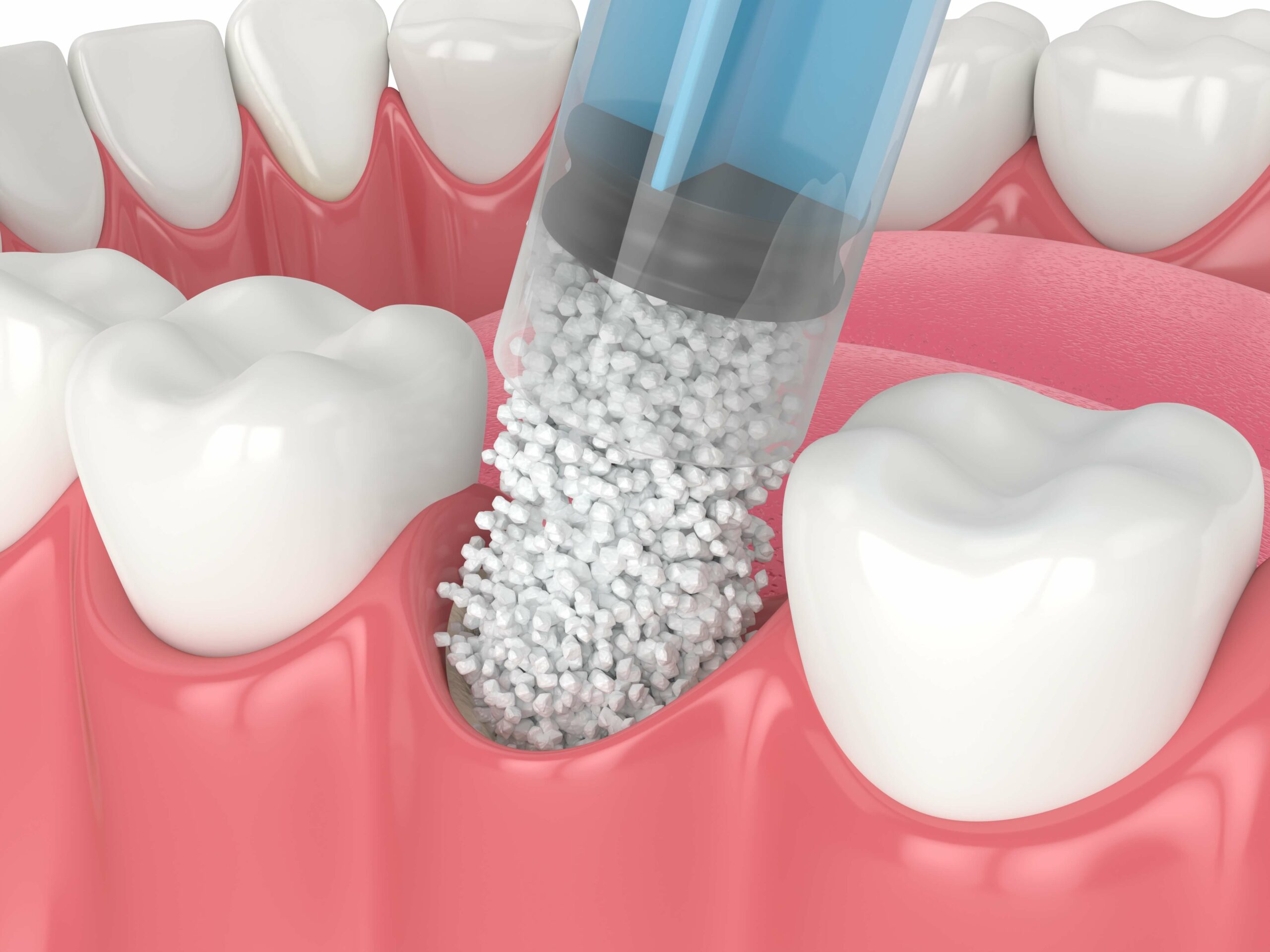 bone grafting for dental implants picture