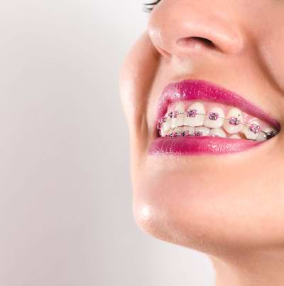 Braces Treatment at Dr. Haroon Clinic the leading dentist in Peshawar.