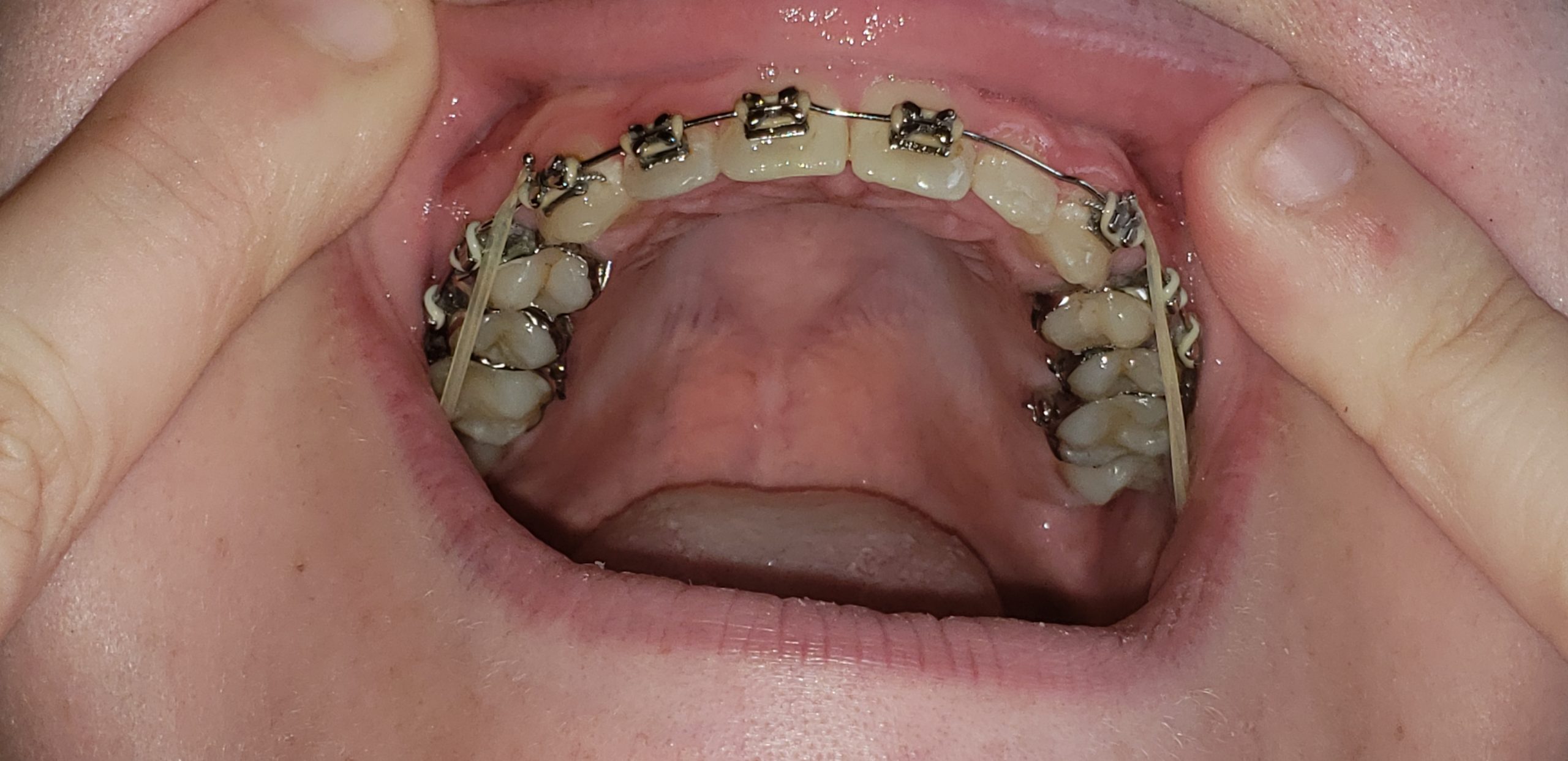 Broken Bracket Braces: Causes, Management, and Prevention