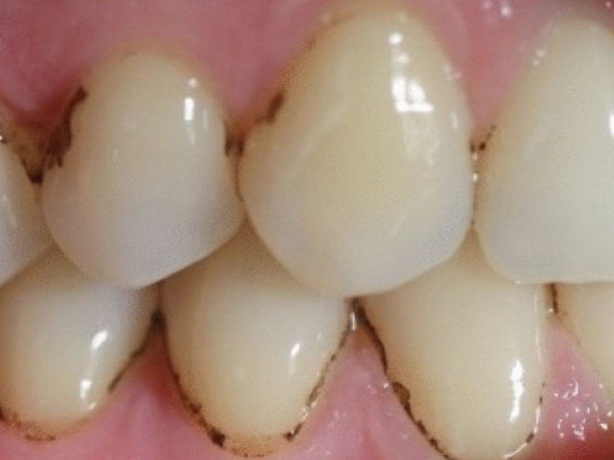 Brown Lines on Teeth: Causes, Prevention, and Treatment