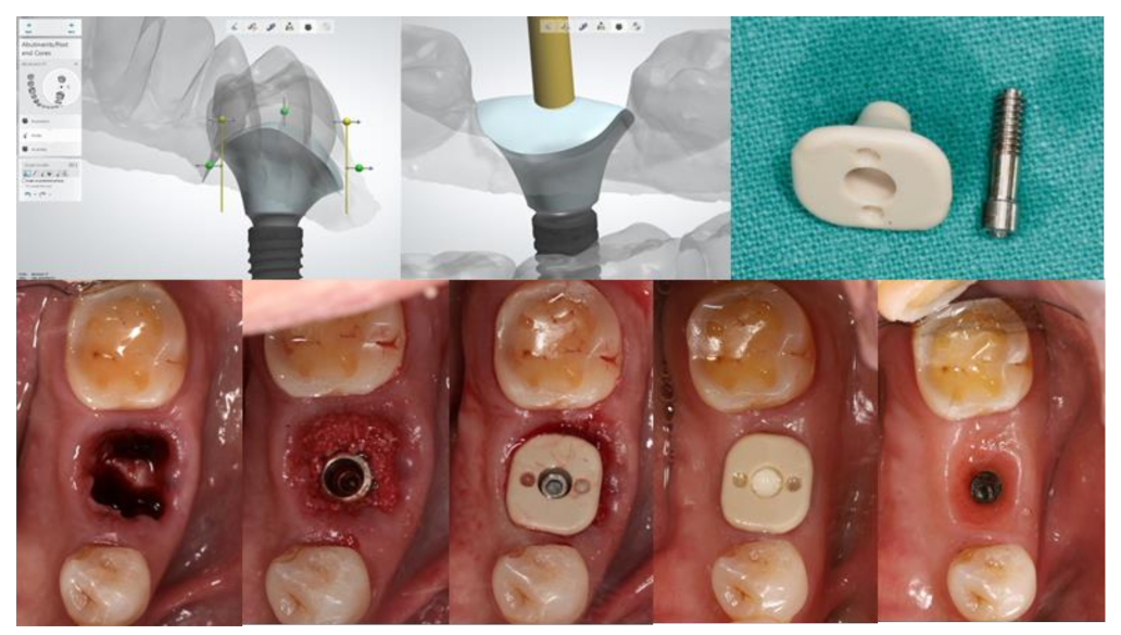 bone graft dental implant healing stages