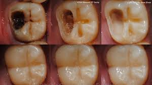 Early-Signs-of-Tooth-Decay-in-Adults-stages-of-tooth-decay