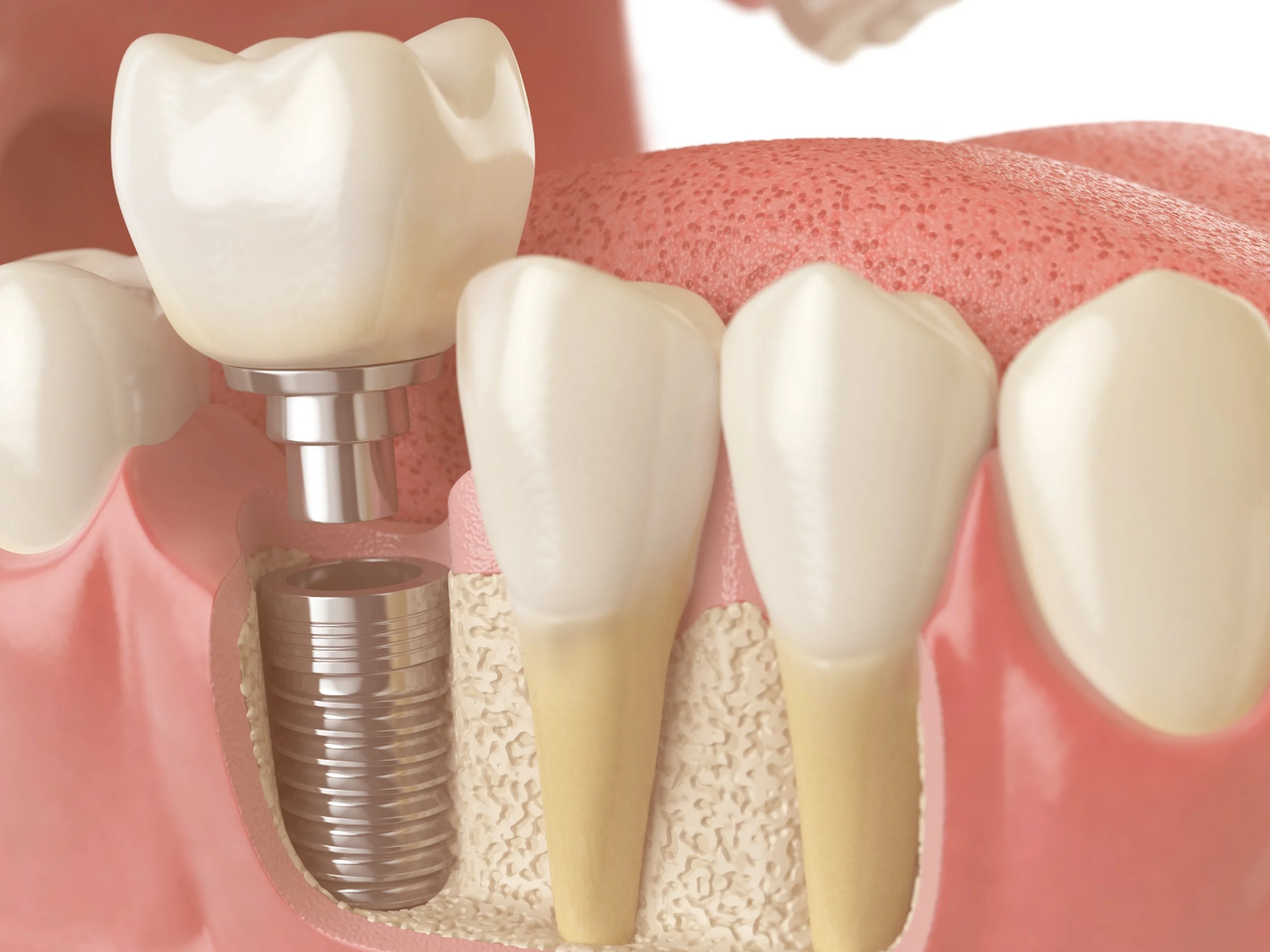 what is the process by which the living jawbone naturally grows around the dental implant?
