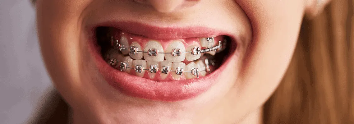 Unhealthy Gums with Braces