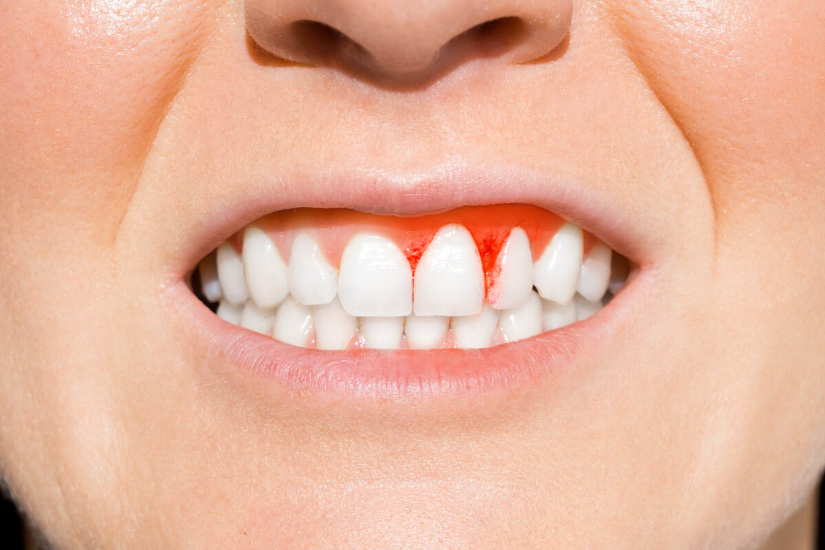 Understanding Gingivitis: Causes, Symptoms, Treatment, and Prevention