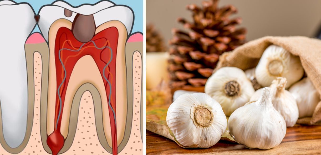 Tooth Decay Pain Relief Home Remedies: Effective Solutions for Immediate Comfort