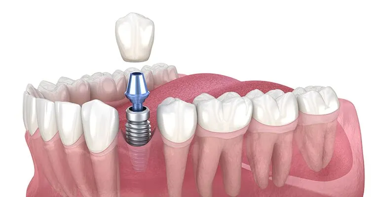 How Long Does a Dental Implant Last?