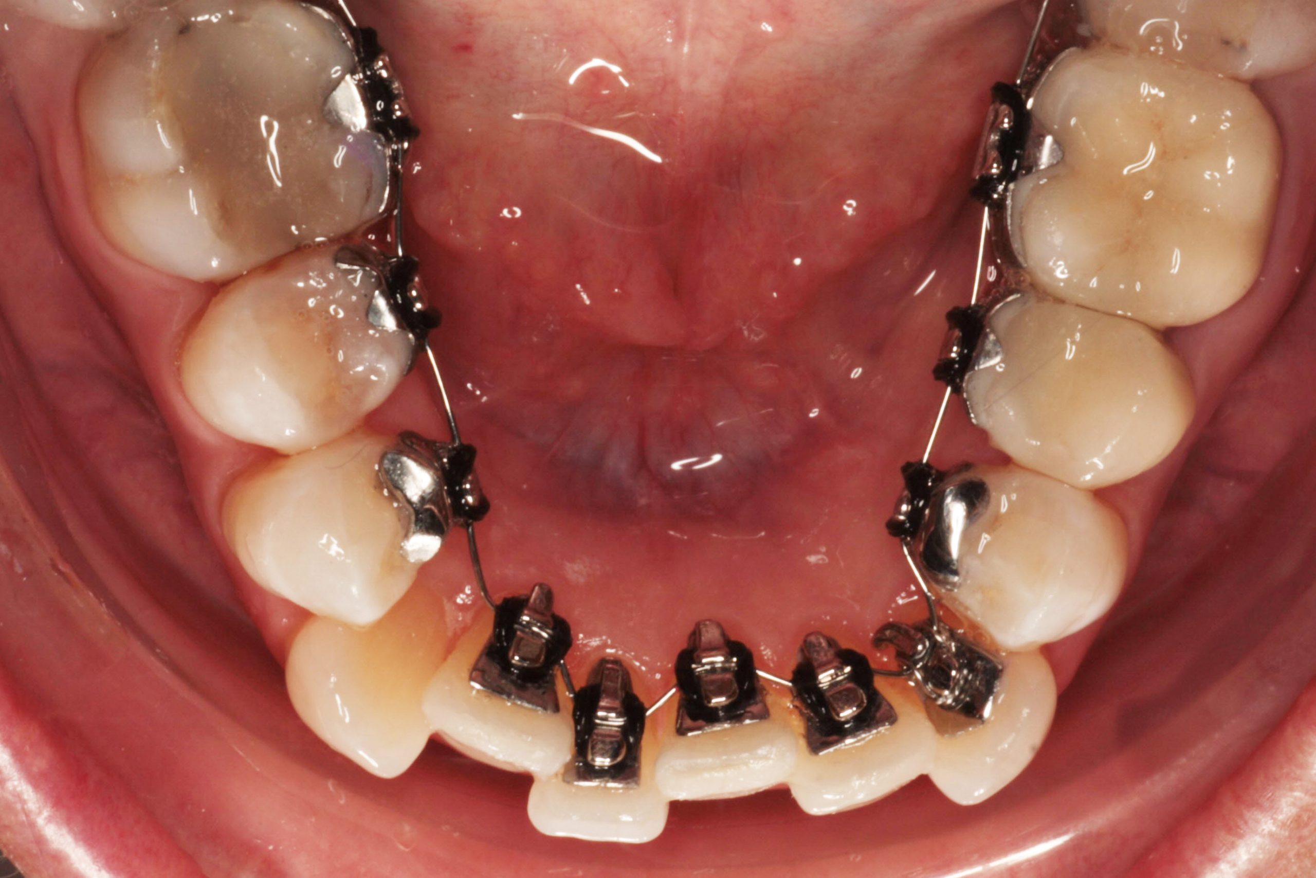 lingual braces patient