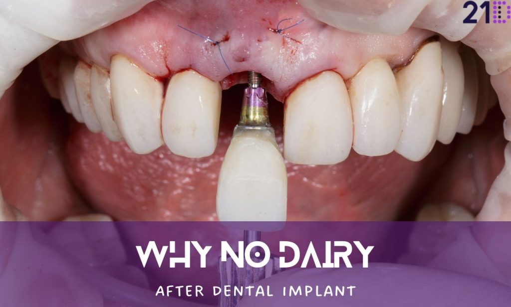 Why No Dairy After Dental Implant: A Comprehensive Guide