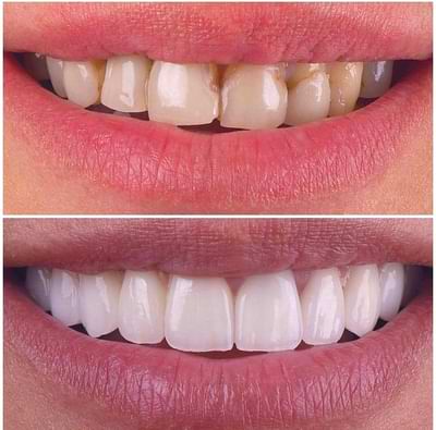 smile makeover at Dr. Haroon Clinic the best dentist in Peshawar