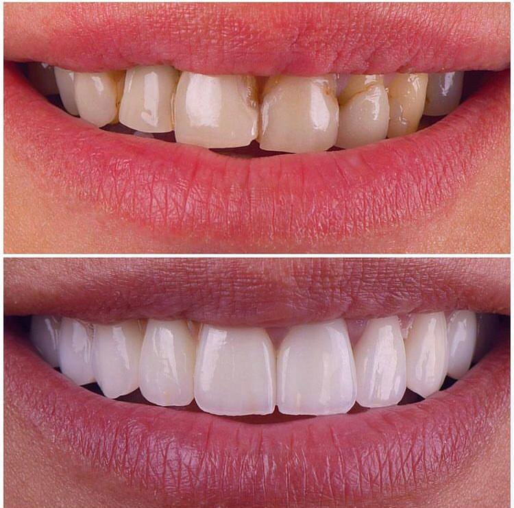 Patient picture showing veneer on his teeth by a dentist in Peshawar