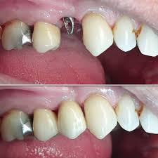 picture of dental implant patient treated by the best dentist in Peshawar.