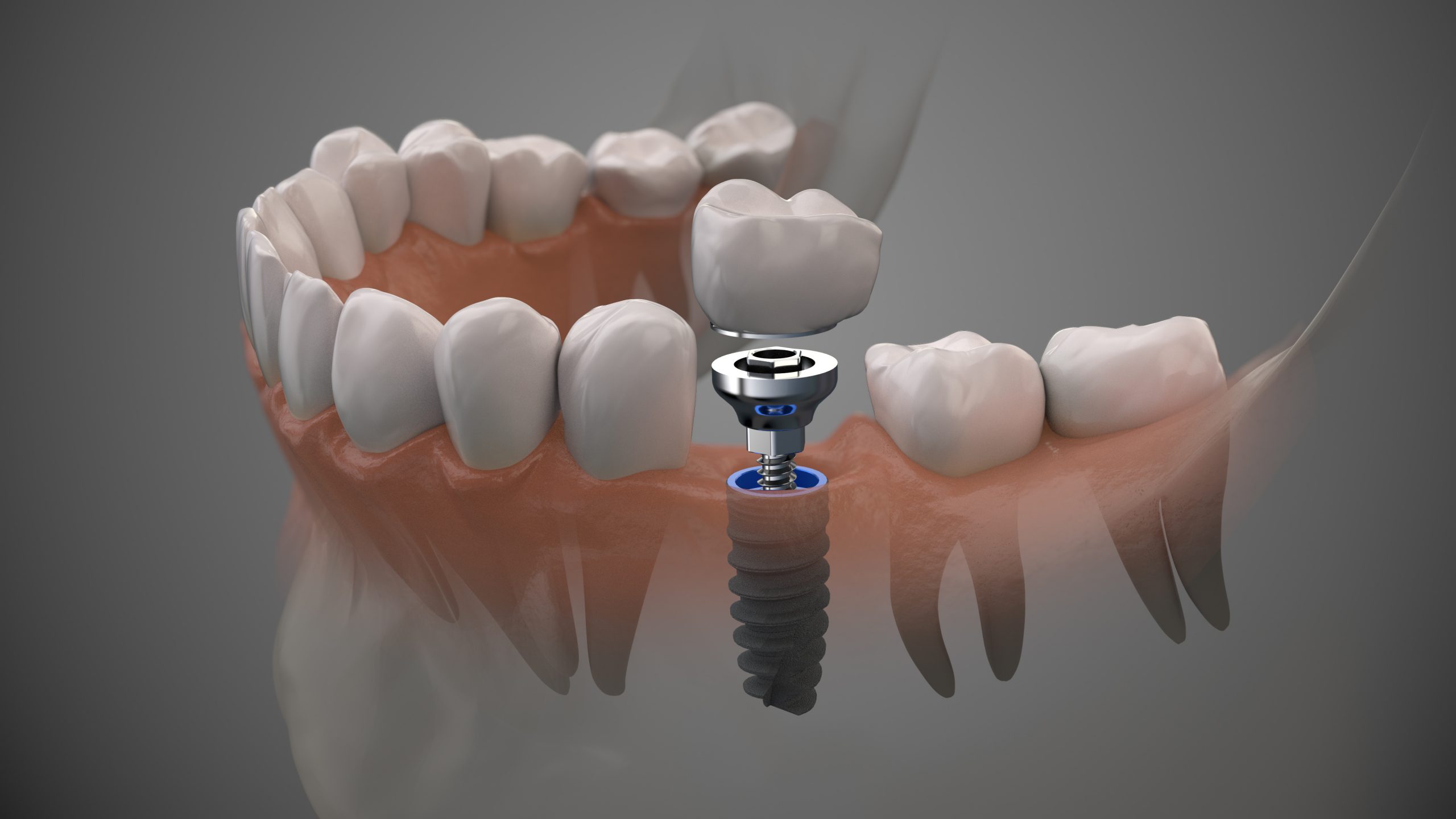 Molar Tooth Implant
