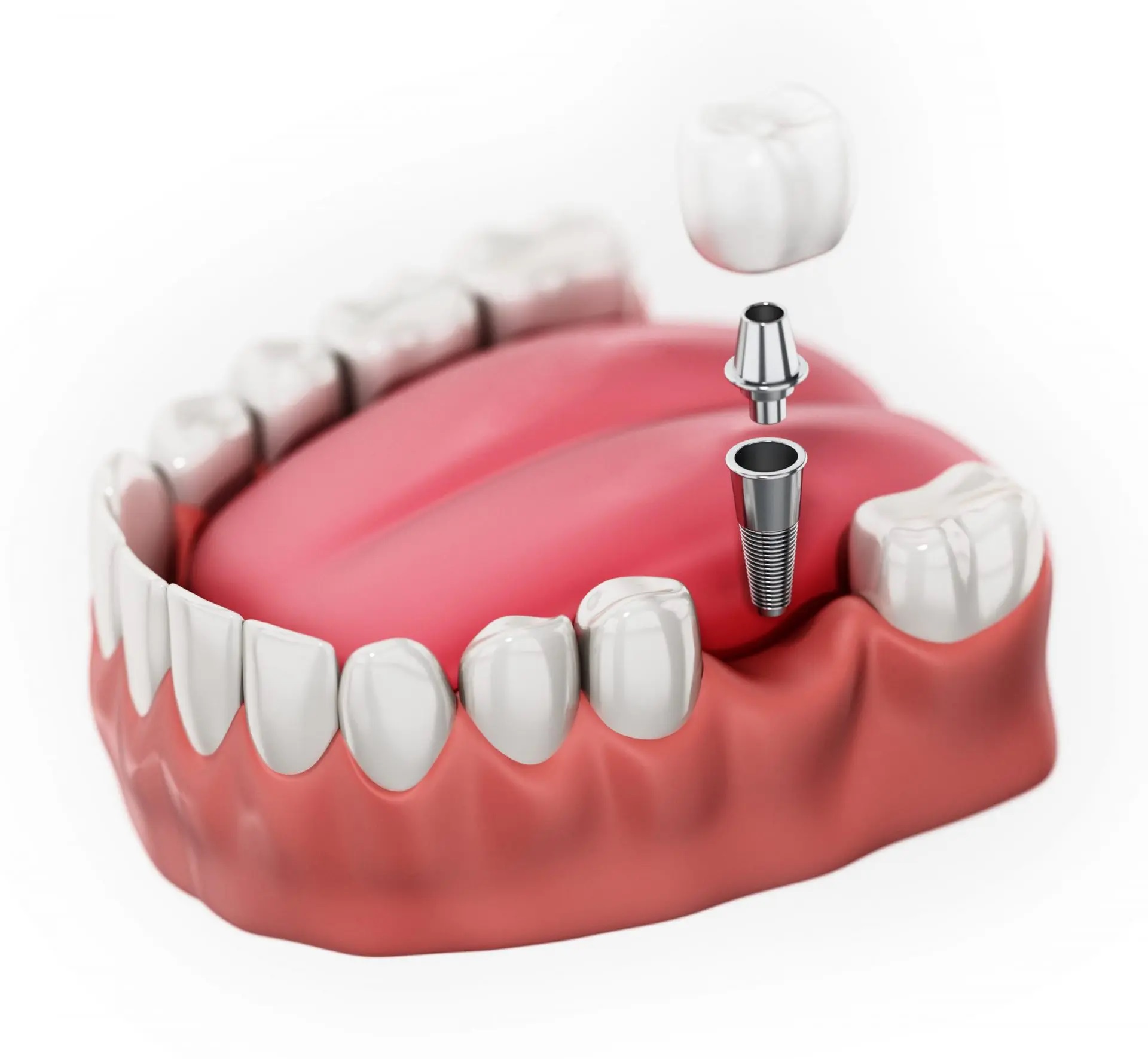 Molar Tooth Implant Animation