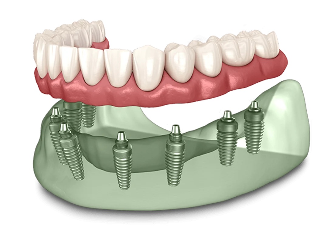 dental implant bridge animation