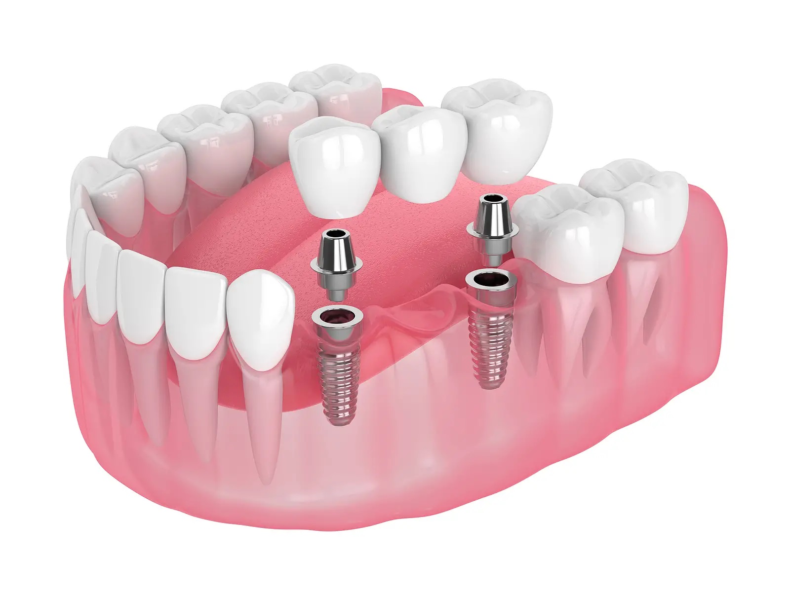 dental implant bridge animation