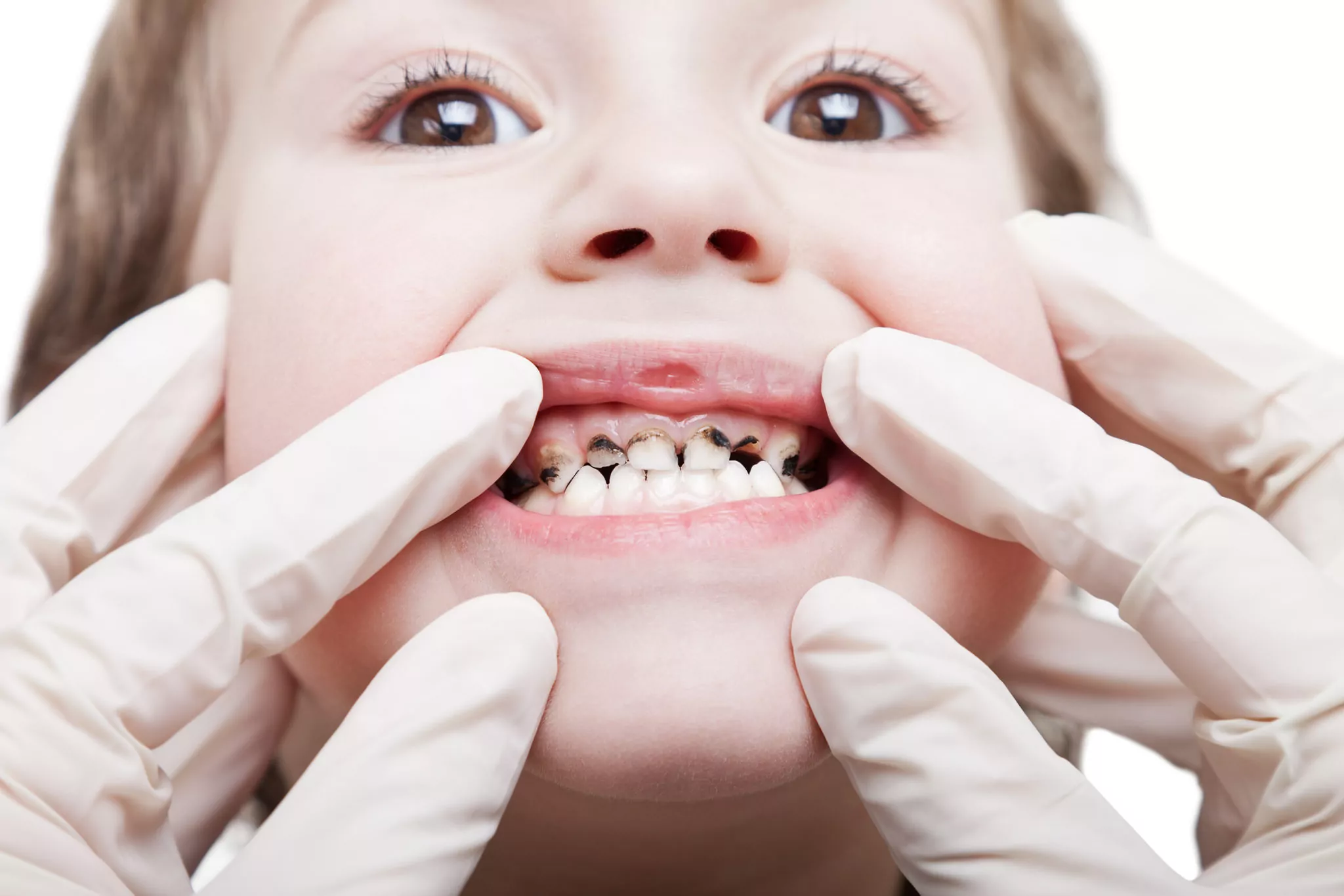 Symptoms of Tooth Decay in Children