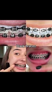 Black Braces: A Comprehensive Guide to Modern Orthodontic Treatment