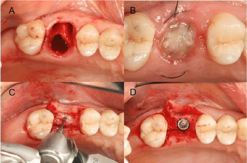 Bone Graft After Tooth Extraction