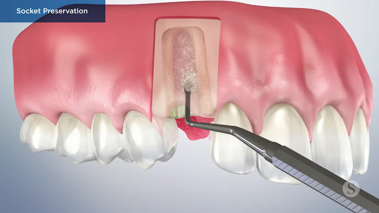 bone grafting for dental implants animation.