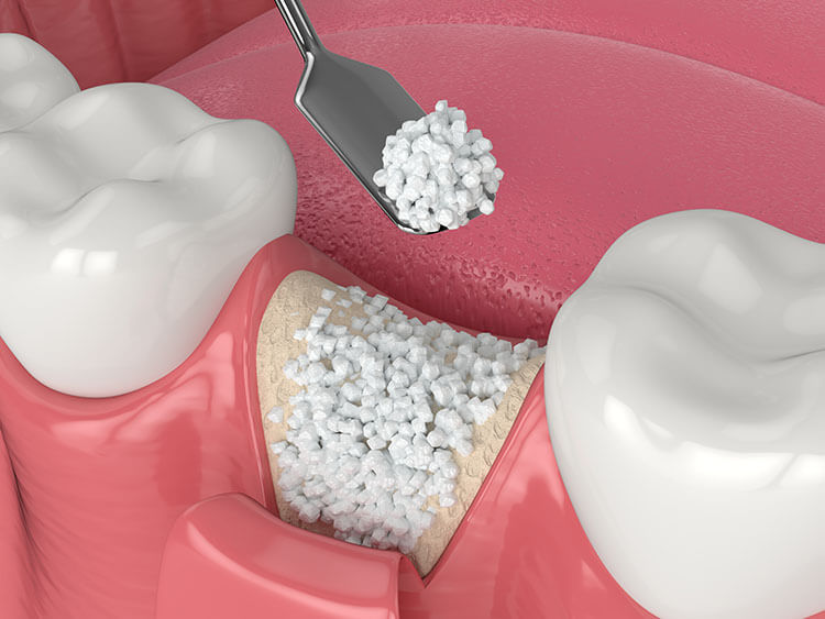 bone grafting for dental implants image
