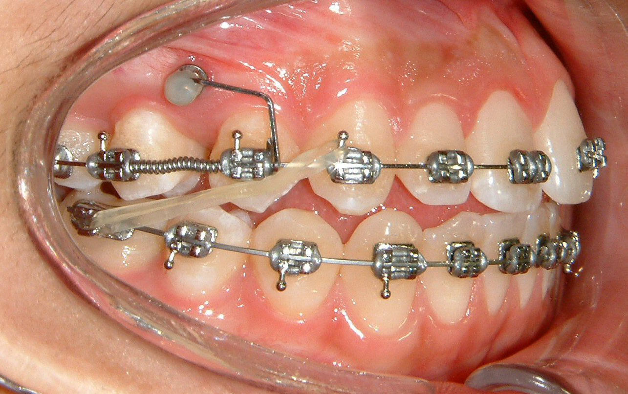 Braces for Overbite: A Comprehensive Guide to Treatment and Care