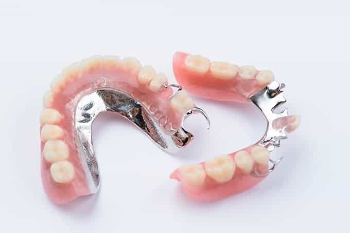 cast metal partial denture