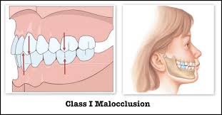 class 1 malocclusion