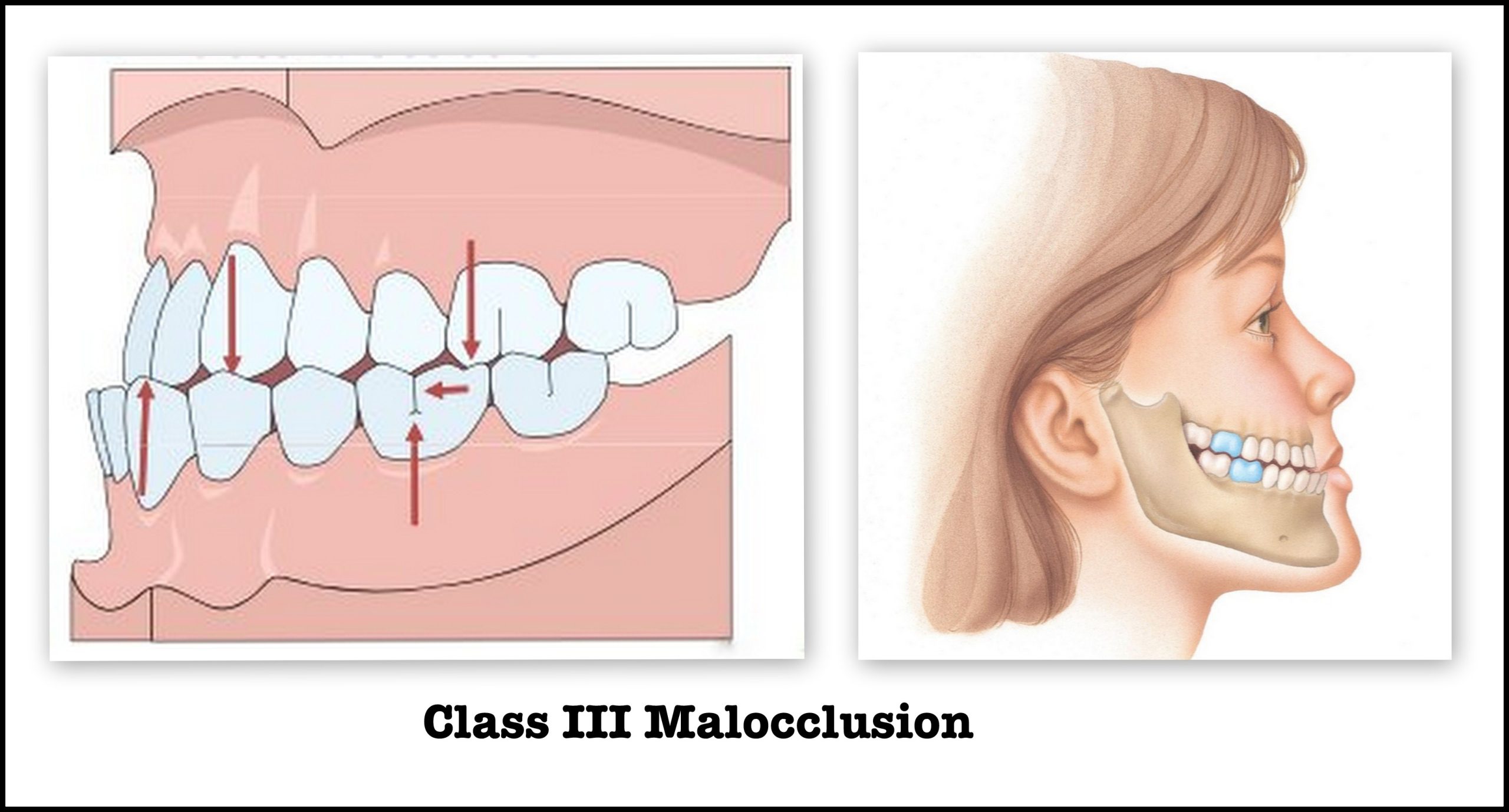 class 3 malocclusion Causes, Diagnosis, and Treatment Options