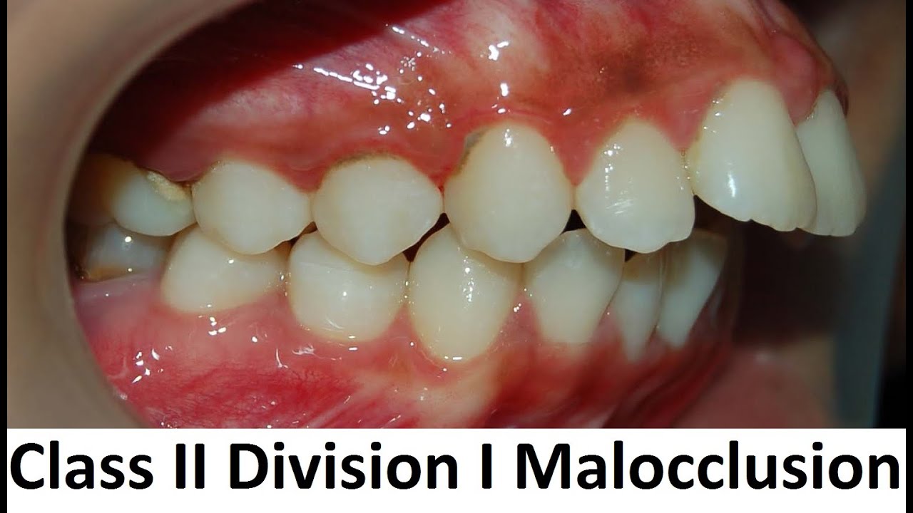 class ii malocclusion division 1