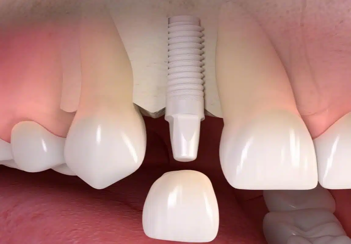 Cosmetic dental implants provide a permanent solution.