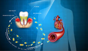 Dental Decay and Heart Disease