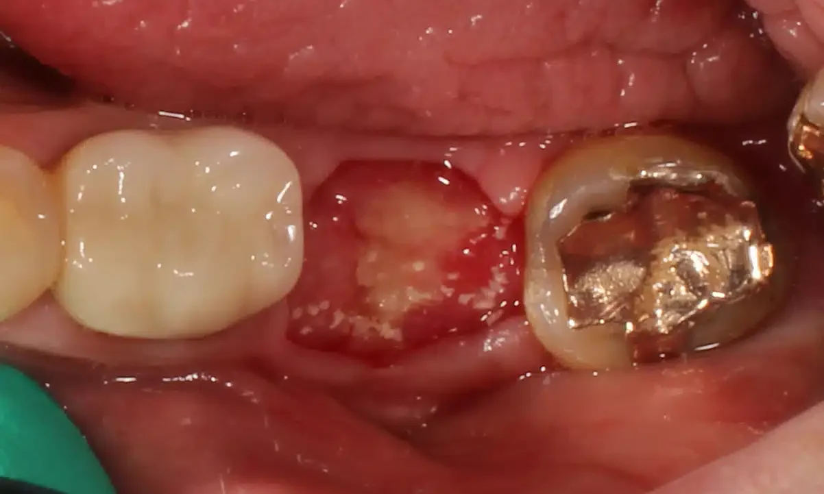 dental implant bone graft healing time