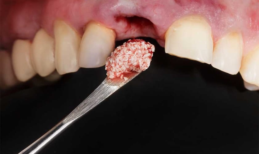 dental implant bone graft rejection