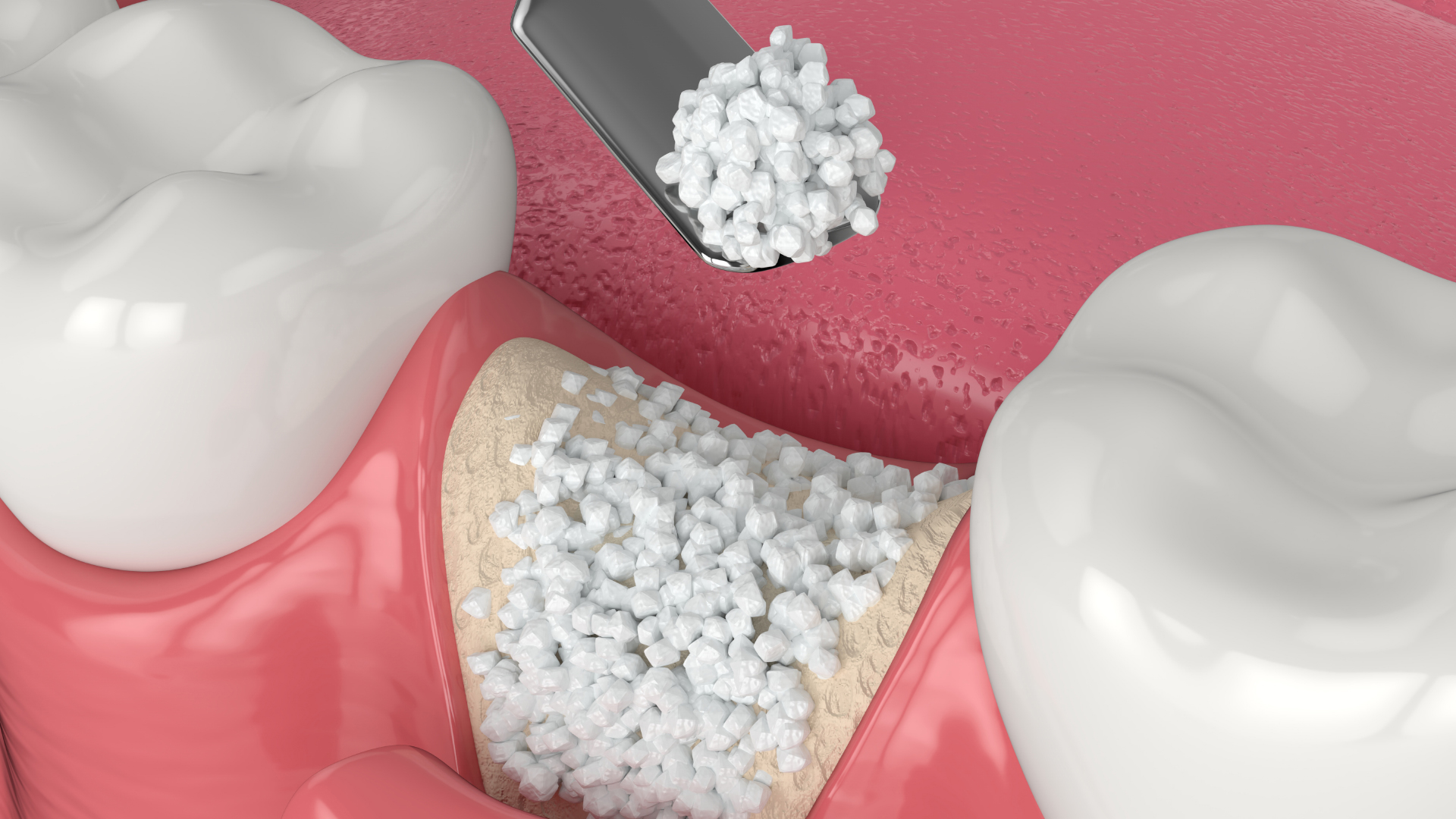 dental implant bone graft success rate