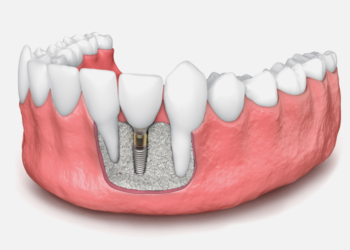 image of Dental Implants with Bone Loss