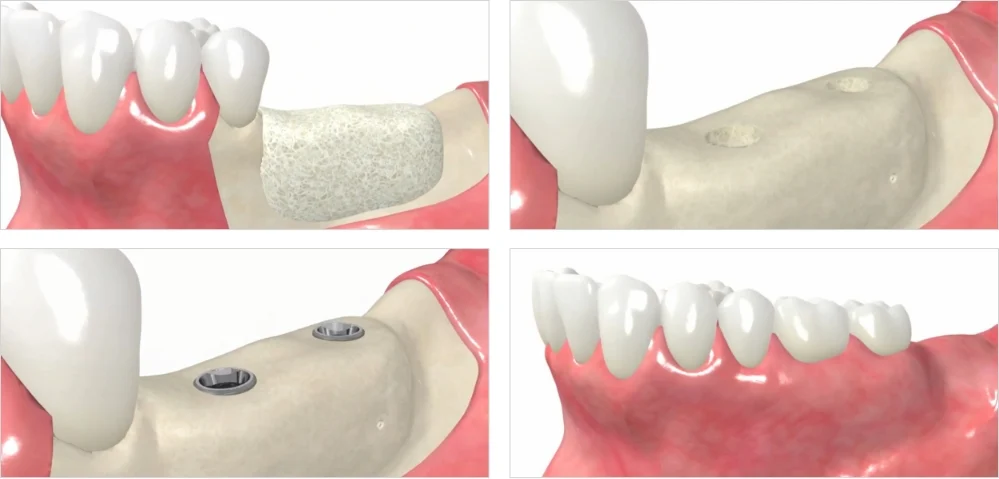 Dental Implants with Bone Loss animated