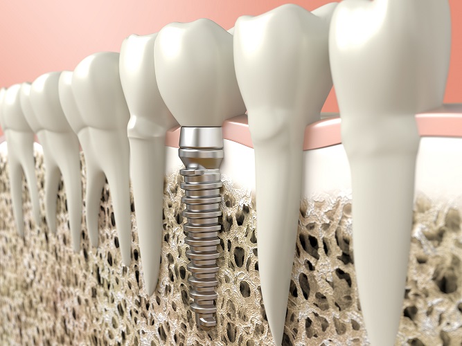 Dental Implants with Bone Loss animation