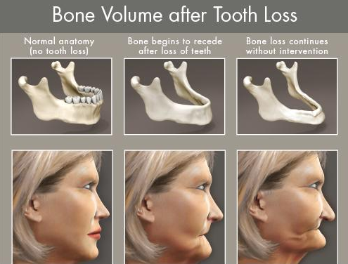 Dental Implants with Bone Loss image.
