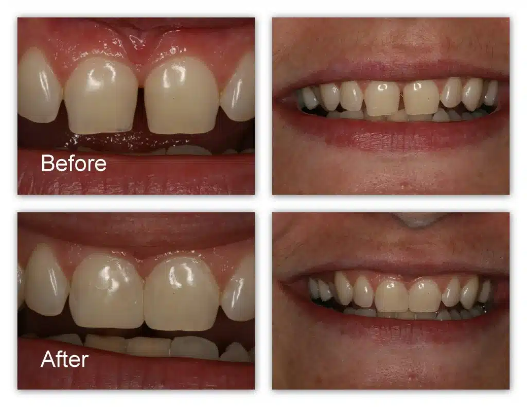 Front Teeth Cavity Filling