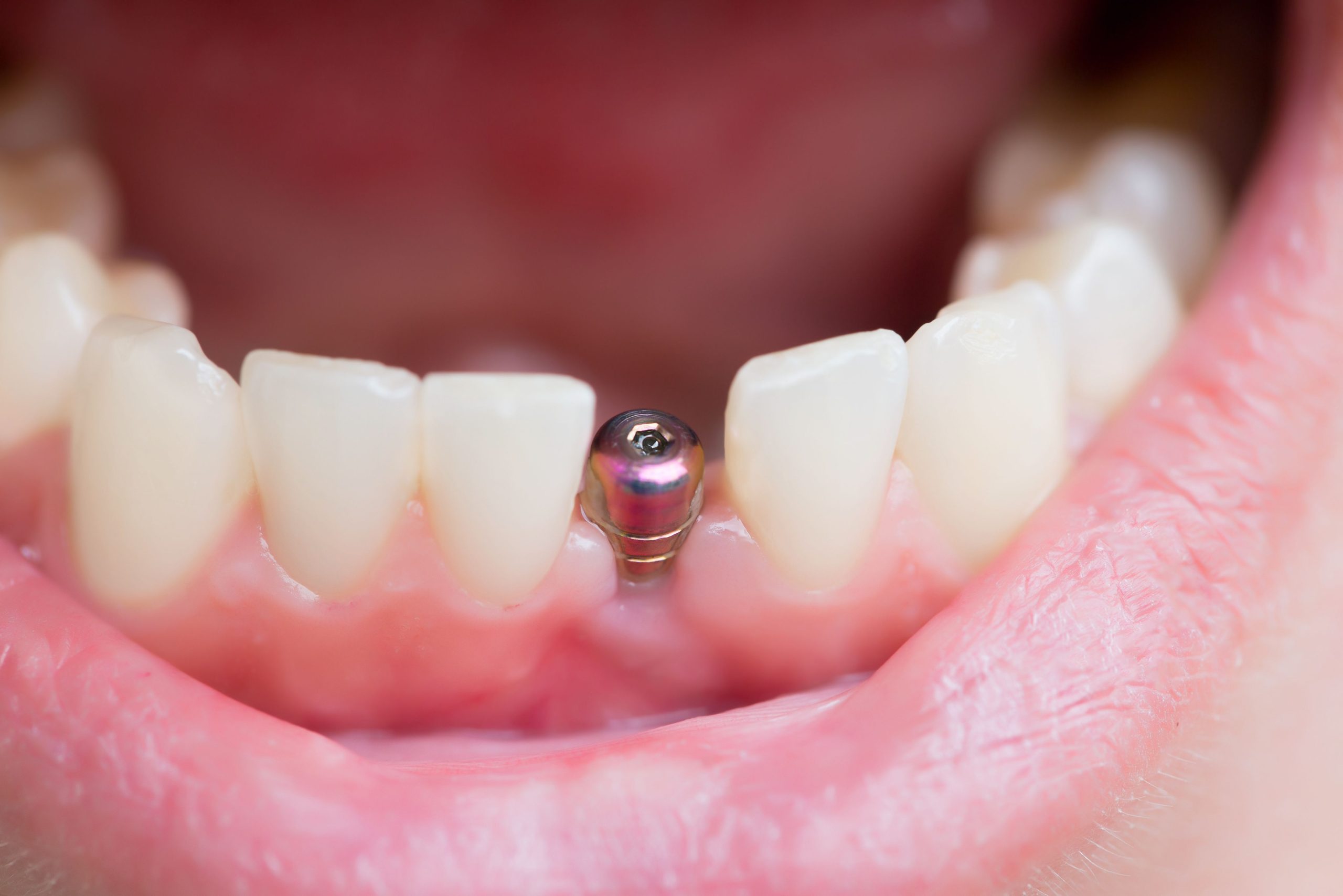 Front teeth dental implants provide a permanent and aesthetically pleasing solution for replacing missing front teeth.