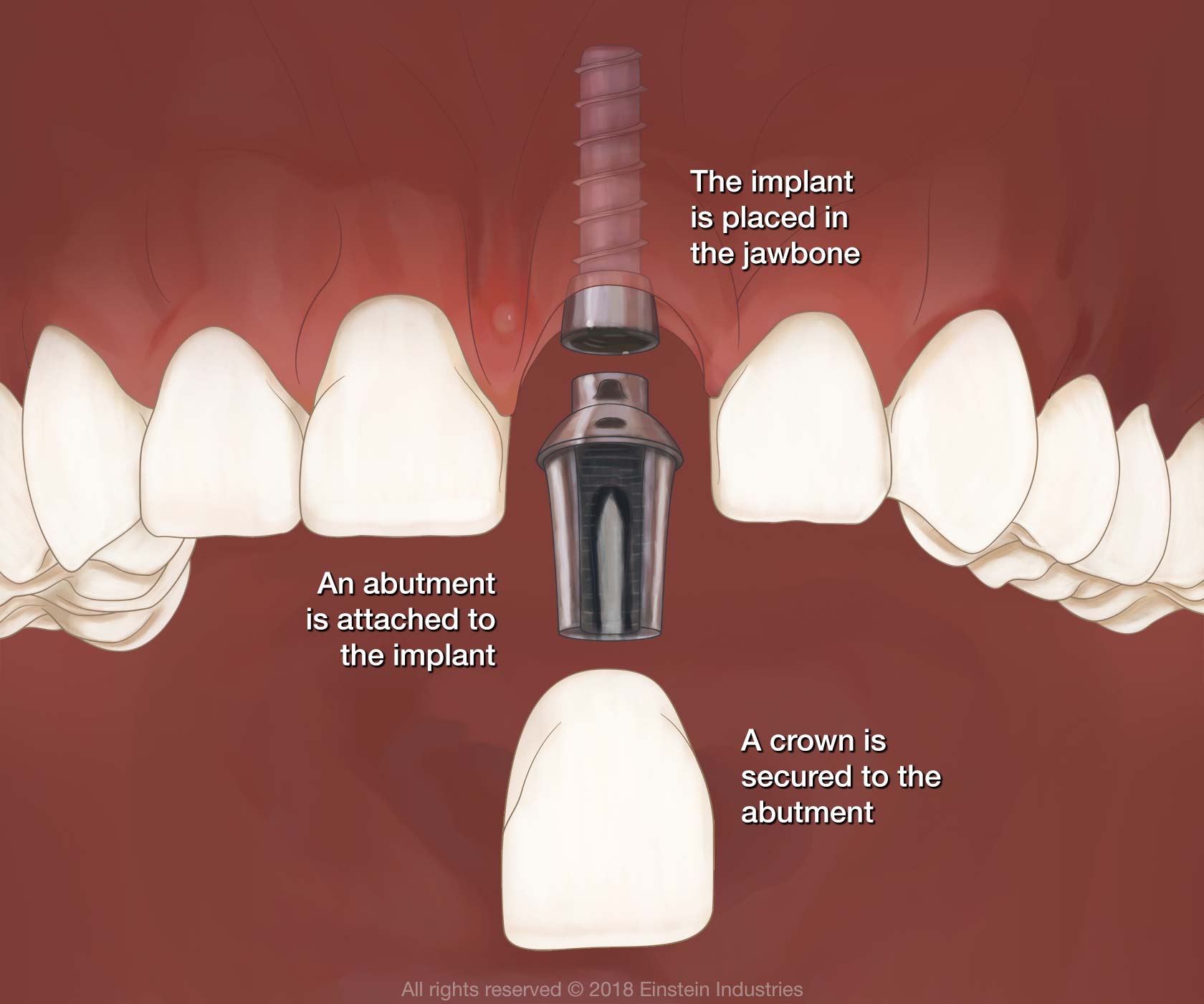 Front teeth dental implants provide a permanent and aesthetically pleasing solution.