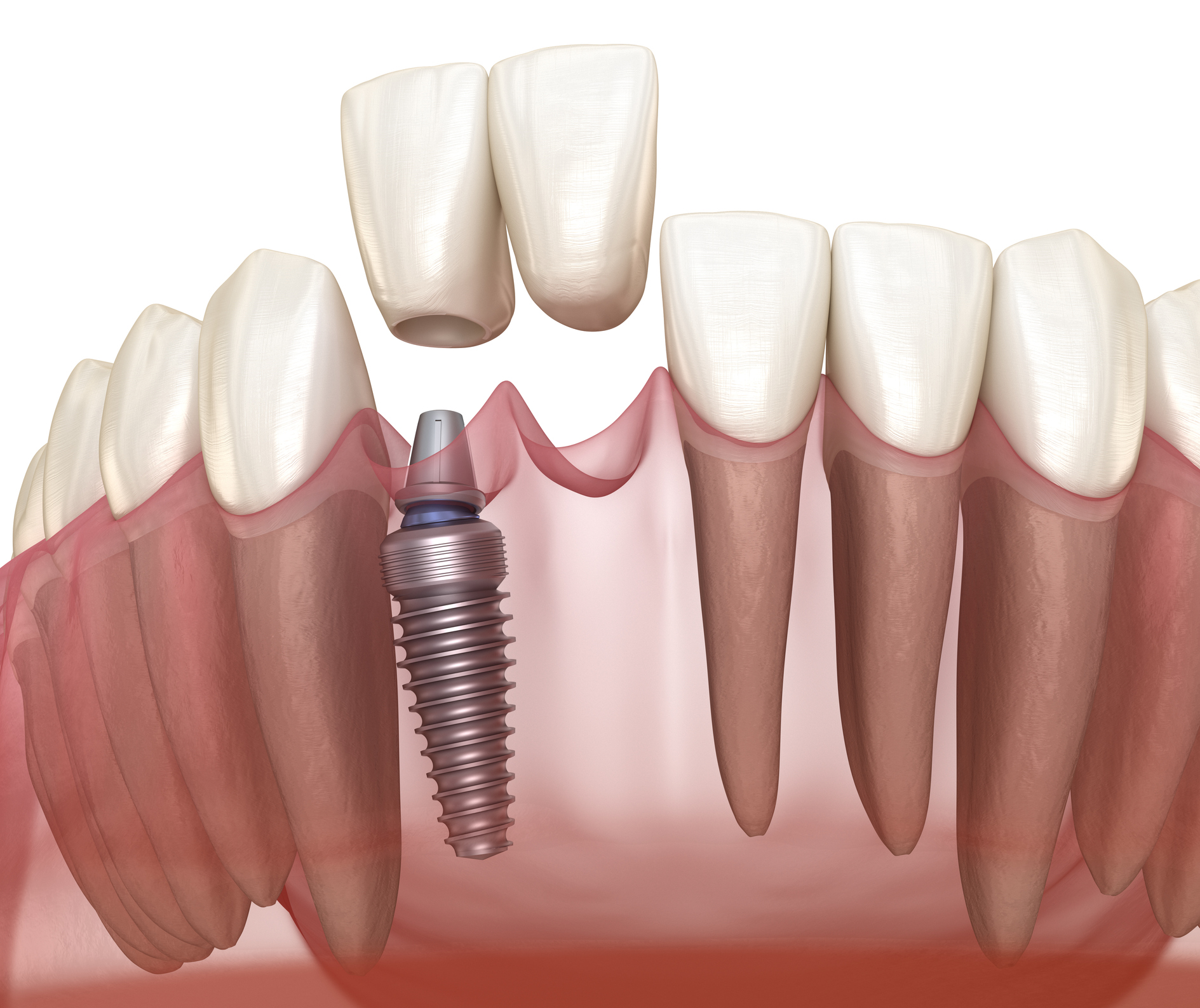 Front teeth dental implants provide a permanent and aesthetically pleasing solution for replacing missing front teeth.
