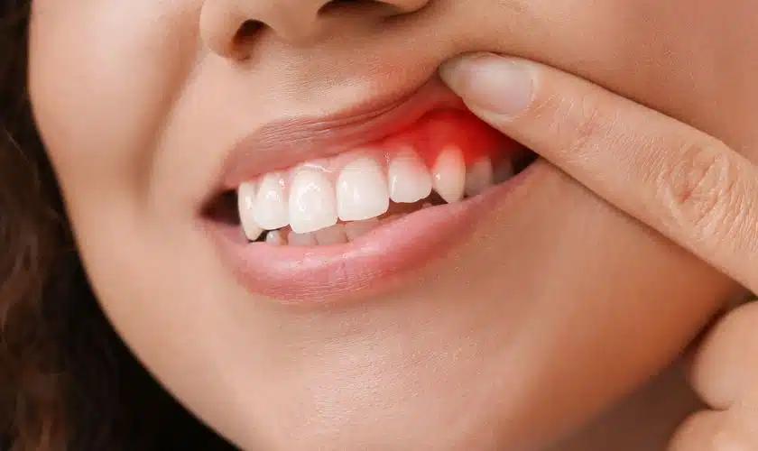 How to Reverse Gum Disease Naturally: A Comprehensive Guide