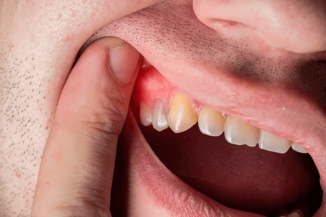 How to Cure Gum Disease Without a Dentist