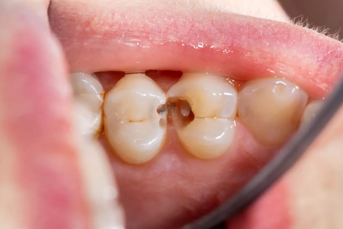 how-to-know-if-you-have-a-cavity-between-teeth