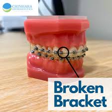 Broken Bracket Braces: Causes, Management, and Prevention