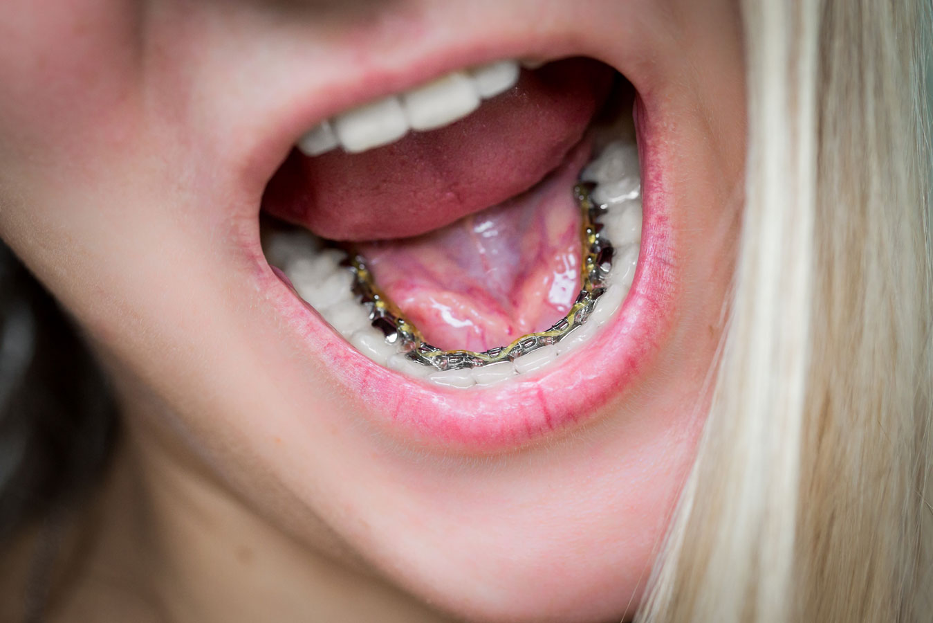 lingual braces patient image