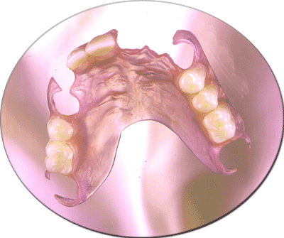 maxillary partial denture